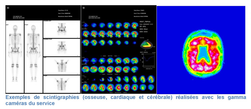 CHU-Amiens-Picardie_images-scintigraphie-osseuse-scintigraphie-cardiaque e-scintigraphie-cerebrale_gamma-cameras