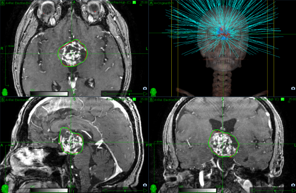 La neuro radiothérapie Au CHU AmiensPicardie CHU AmiensPicardie